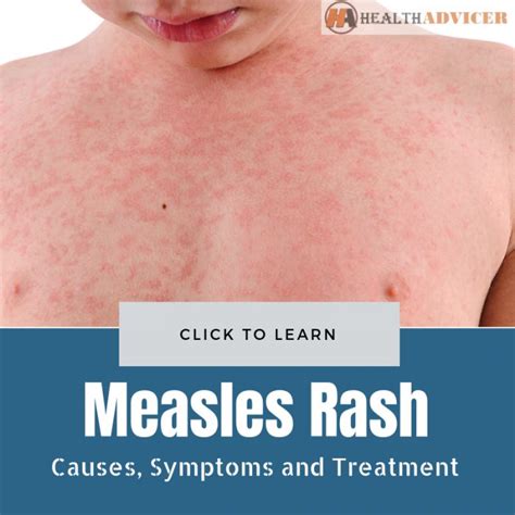 Measles Rash Causes Picture Symptoms And Treatment