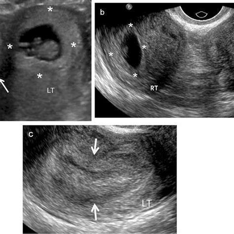 A Year Old Woman With Cervical Ep Longitudinal Ultrasound Image Of Hot Sex Picture