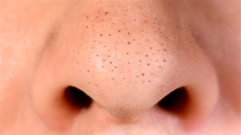 Heres What You Need To Know Before Removing Blackheads