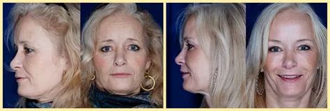 Facial Fat Transfer Danville Blackhawk Plastic Surgery And Medspa