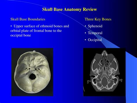 Ppt Skull Base Review And Pathology Melissa Durand Hartford Hospital