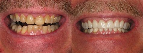 Complete Dental Restoration Dental Restoration With Empress Cosmetic Porcelain Crowns Dental
