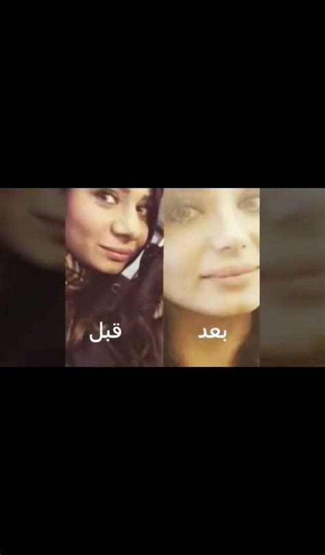 من أجل إجراء تشخيص اقصائي وإجراء تشخيص نهائي للفيروس، يجب الاتصال بأقرب قسم للطوارئ في حالة وجود شكوى تتعلق بالمرض ويجب إجراء الفحوصات المطلوبة من قبل الطبيب. خطيبه بكر خالد هيفاء حسوني قبل وبعد عمليات التجميل والغش ...