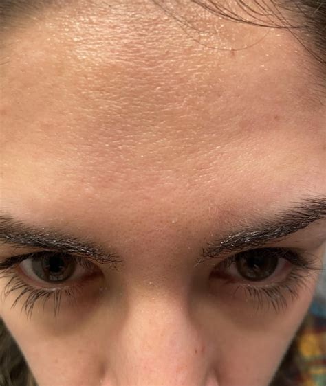 Skin Concerns Help W Scaly Patch On Forehead Skincareaddiction