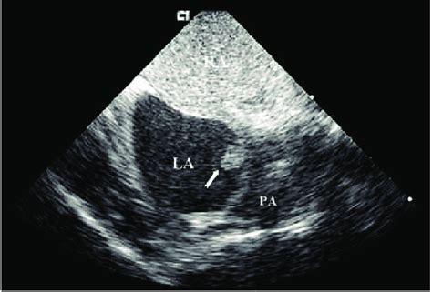 A Patent Foramen Ovale Pfo Documented By Micro Bubbles Entering The