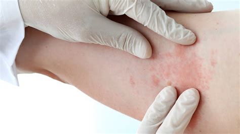 Dermatite atopica non più solo un problema dei bambini Paideia International Hospital