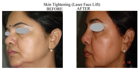 Laser Face Lift Amrit Clinic