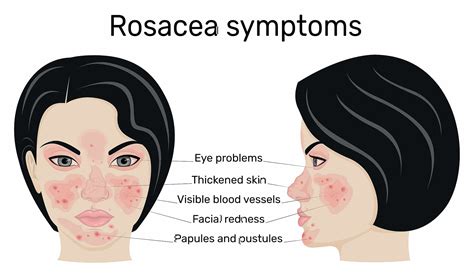 What Causes Itchy Rosacea And How To Soothe It Sl Aesthetic Clinic