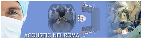 Acoustic Neuroma Ear Institute Of Chicago