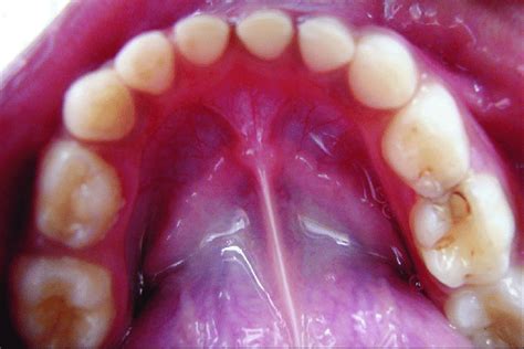 Dental Caries Was Present In Left Mandibular First And Second Primary