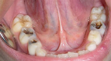 Tooth Decay Dental Caries The Dental Arcade Blog