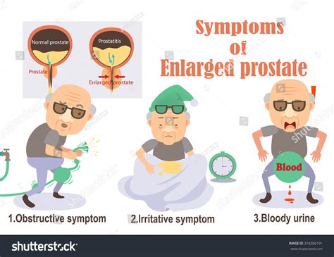 Symptoms Enlarged Prostate Infographicvector Illustration