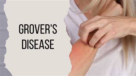 What Is Grover Disease And Tips To Reduce It Sehat Nagar