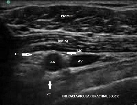 Infraclavicular Region Sonoanatomy Showing Cords Of Brachial Plexus As