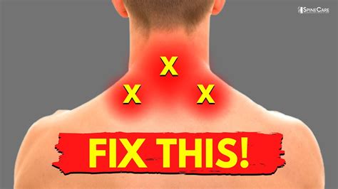 How To Quickly Relieve Pain At The Base Of The Neck Youtube