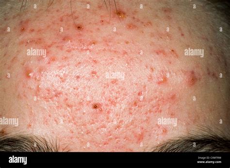Erythematous Skin Hi Res Stock Photography And Images Alamy