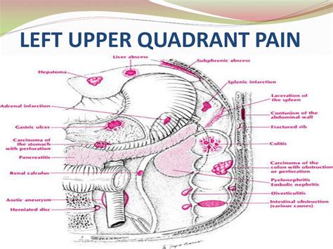 Ppt Left Upper Quadrant Pain And Masses Powerpoint