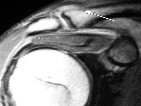 Mr Imaging Appearances Of Acromioclavicular Joint Dislocation