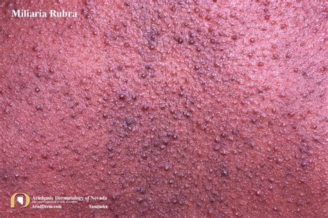 Miliaria Rubra Heat Rash Prickly Heat Academic Dermatology Of Nevada