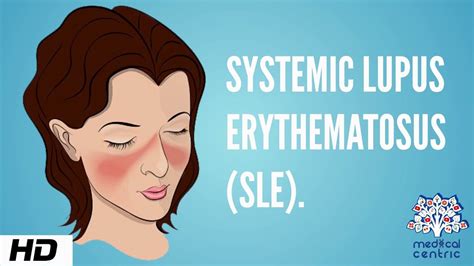 Systemic Lupus Eythematosus Sle Causes Signs And Symptoms