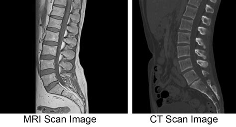 MRI Vs CT Scan Diagnosing Spine Neck Injuries Degenerative