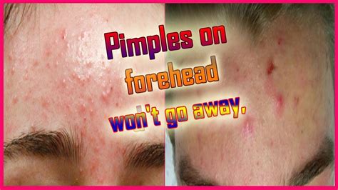 Pimplesacne On Forehead Causes And Treatment Youtube