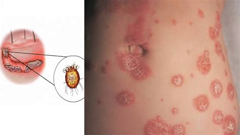 A readily treatable infestation, scabies remains common primarily because of diagnostic difficulty, inadequate treatment of patients and their contacts, and improper environmental control measures. Sarna: escabiose - Espaço Saúde! - FCiências