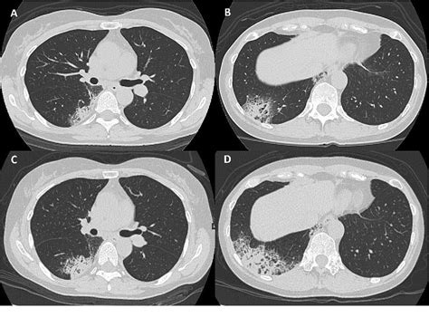 Figure From Transbronchial Lung Cryobiopsy In Idiopathic Acute Fibrinous And Organizing