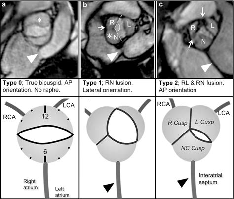 Comprehensive 4 Stage Categorization Of Bicuspid Aortic Valve Leaflet Morphology By Cardiac Mri