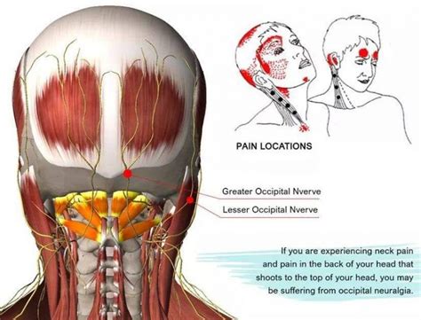Occipital Neuralgia Helped By Upper Cervical Care Advanceuc Com My Xxx Hot Girl