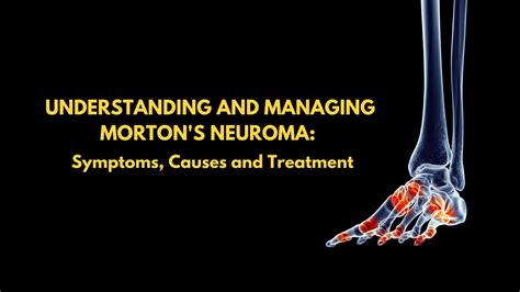 Understanding And Managing Mortons Neuroma Symptoms Causes And Trea
