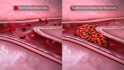 Sickle Cell Vs Normal Cell