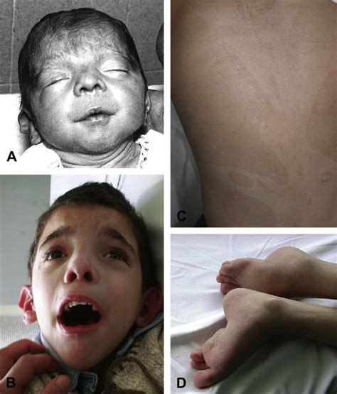 Figure From Patau Syndrome With Long Survival In A Case Of Unusual Mosaic Trisomy