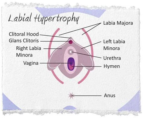 Labial Hypertrophy Northeast Ohio Urogynecology Urogynecology Pelvic Reconstructive