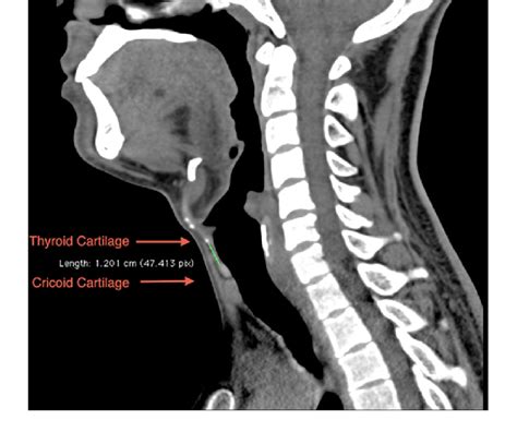 Sample Ct Image Demonstrating The Maximum Midline Height Of The