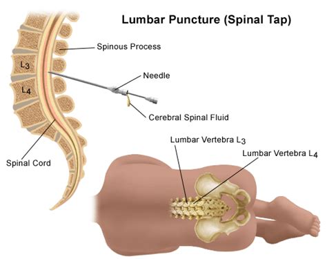 Lumbar Puncture Procedure How To Do And Recover New