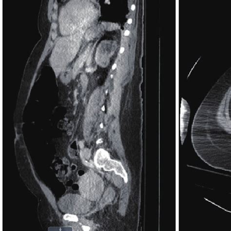 Ct Abdomenpelvis With Contrast Coronal Sagittal And Axial Views