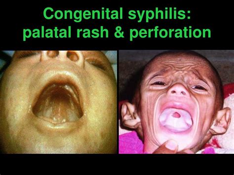 Congenital Syphilis Saddle Nose