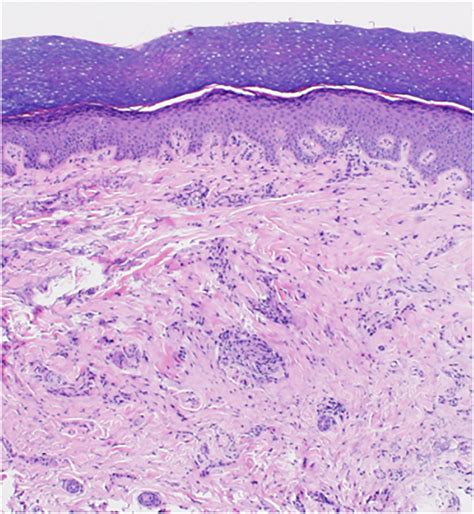 Acral Skin With Epithelioid Granulomas Within The Dermis And Sparse