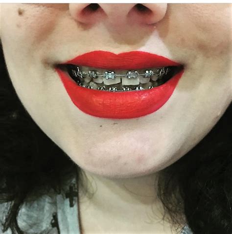 Pin By Evil H On Kissable Dental Braces Braces Girls Teeth Braces