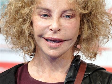 Bevor man sich blind zu einem termin entscheidet, sollte man ganz genau verstehen zu wem man geht und was genau er spritzt!. Beautywahn: Entstelltes Gesicht & viel Tragik | Promiflash.de