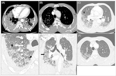 Ct Scan Of The Chest Acute Chest Syndrome And Covid‐19‐induced