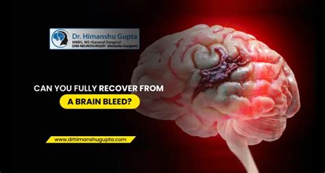 Can You Fully Recover From A Brain Bleed In 2022 Brain Hemorrhage