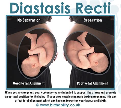 Diastasis Recti What Does It Mean For Pregnant And Postnatal Women