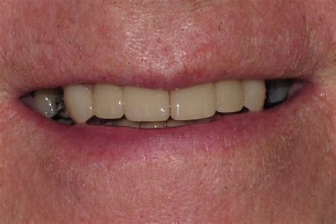 Dental Bridges Smile Gallery Raber Dental Kidron Dentist