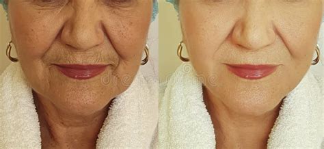 Elderly Woman Wrinkles Face Before After Rejuvenation Correction