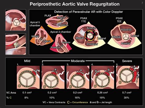 Periprosthetic Aortic Valve Regurgitation Grading Grepmed