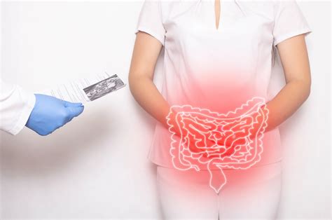 New Ulcerative Colitis Patient Education Now Available American
