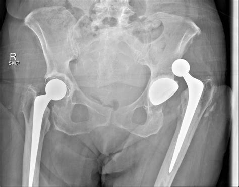 An Unusual Complication Of Hip Dislocation After Total Hip Replacement