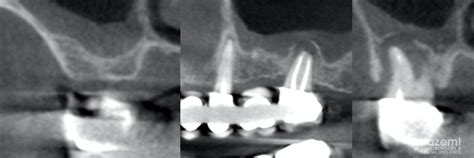 Bone Grafting And Repair Of Sinus Perforation Following Tooth Extraction Bone Grafting And